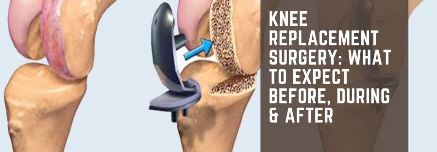 Knee Replacement Surgery_ What to Expect Before, During & After