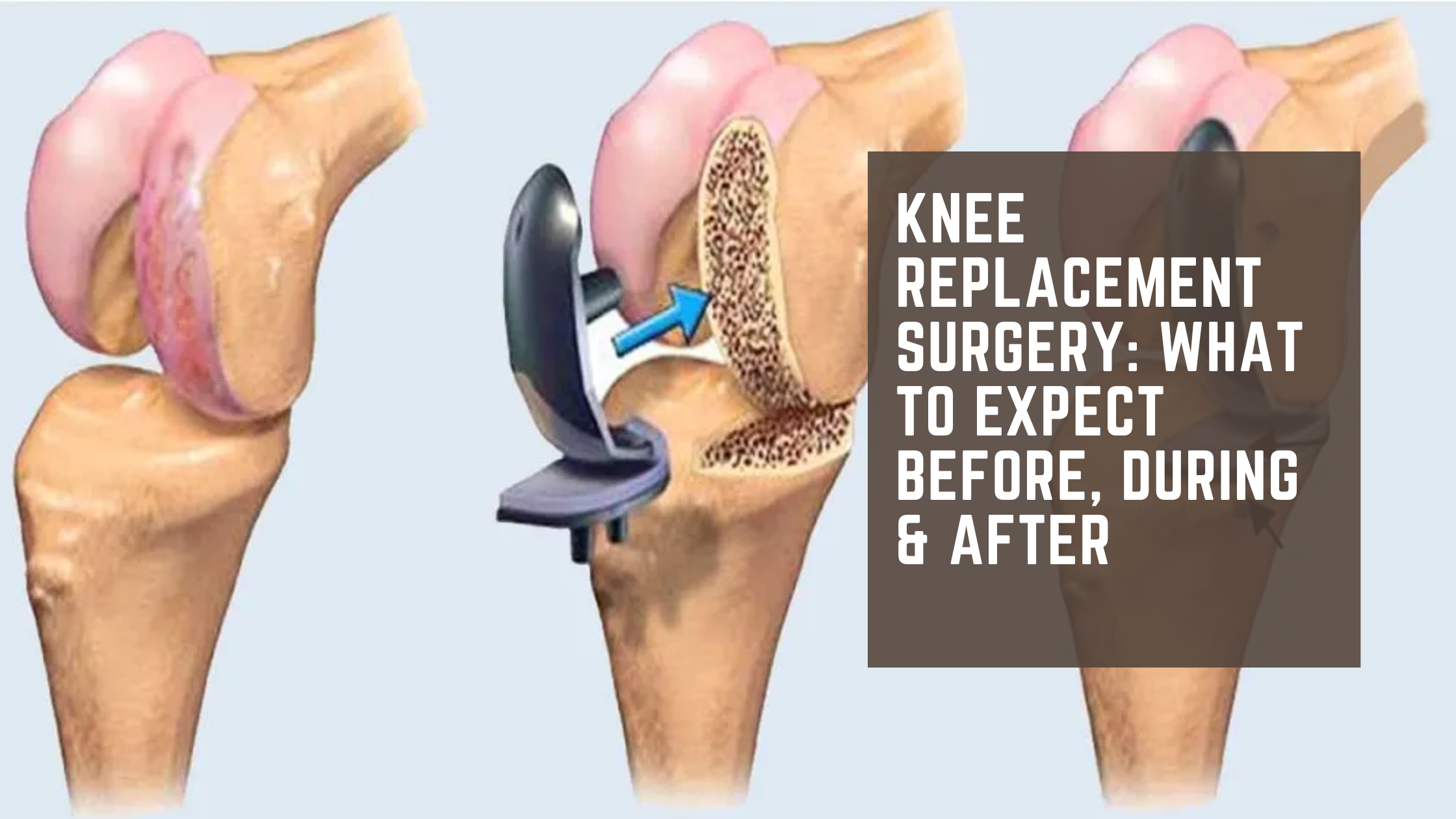 Knee Replacement Surgery_ What to Expect Before, During & After